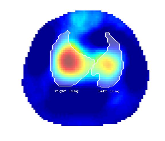 Mit der neuen Methode lässt sich die Lungenfunktion untersuchen.