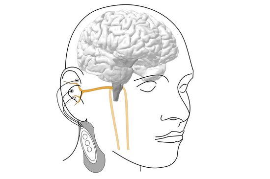 Sketch of a head with electrodes attached to the ear and a small device worn on the neck.