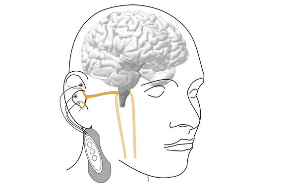Sizze eines Kopfes mit Elektroden am Ohr und einem kleinen Gerät, das am Hals befestigt ist.