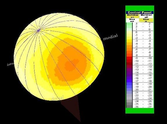 Die Verschleißzonen der Gelenkskugeln werden – ähnlich wie Landkarten - erfasst.