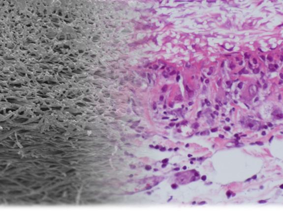 Das künstliche Material (links) und das Biomaterial (rechts) lassen sich gut kombinieren. (Fotomontage) Das künstliche Material (links) und das Biomaterial (rechts) lassen sich gut kombinieren. (Fotomontage)