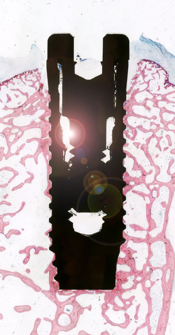 Querschnitt durch ein Zahnimplantat aus Titan