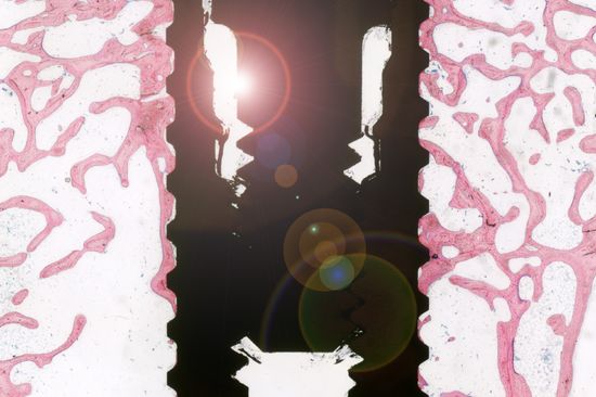 Querschnitt durch ein Zahnimplantat aus Titan