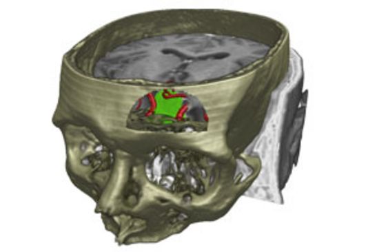Die Kombination verschiedener medizinischer Bildmodalitäten (CT, MR, MRA) in einer 3D Darstellung ermöglicht die patientenindividuelle präoperative Planung neurochirurgischer Eingriffe.