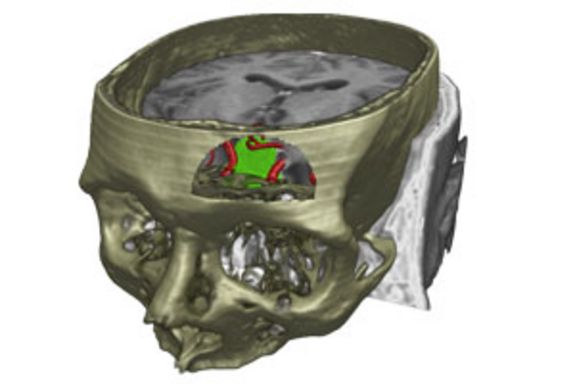 Die Kombination verschiedener medizinischer Bildmodalitäten (CT, MR, MRA) in einer 3D Darstellung ermöglicht die patientenindividuelle präoperative Planung neurochirurgischer Eingriffe. Die Kombination verschiedener medizinischer Bildmodalitäten (CT, MR, MRA) in einer 3D Darstellung ermöglicht die patientenindividuelle präoperative Planung neurochirurgischer Eingriffe.