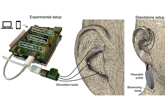 Sketch showing at which points in the auricle the stimulation takes place.