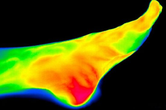 Thermobilder werden zur Erfassung der Durchblutungsverbesserungen eingesetzt. Mit freundlicher Unterstützung durch InfraTec GmbH